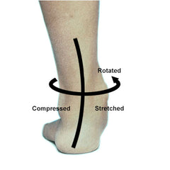 Foot overpronation